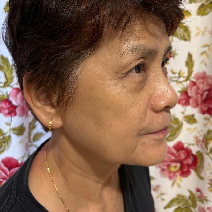 Ms Eng's face on day twenty-eight, looking smoother and more radiant