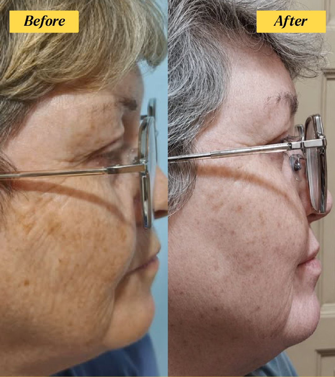 Ms Angela before and after 28 days of argan oil